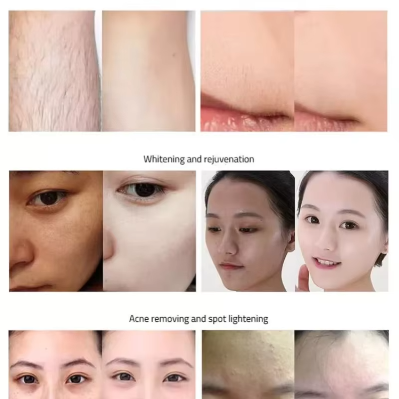 IPL OPT results before after